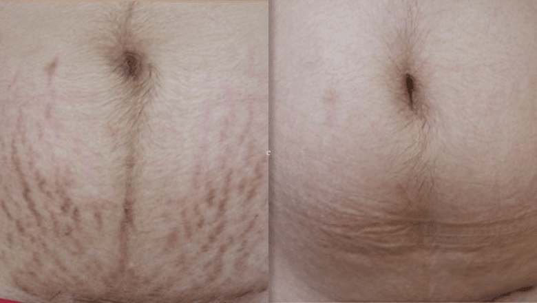 stretch mark removal laser before after