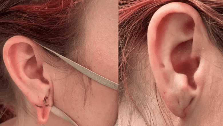 stretched earlobe repair before after 2