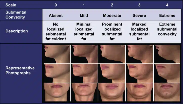 submental fat classification