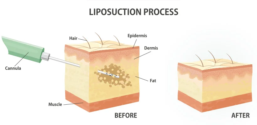 chin liposuction procedure