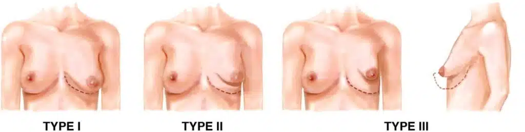 tuberous-breast-deformity-classification