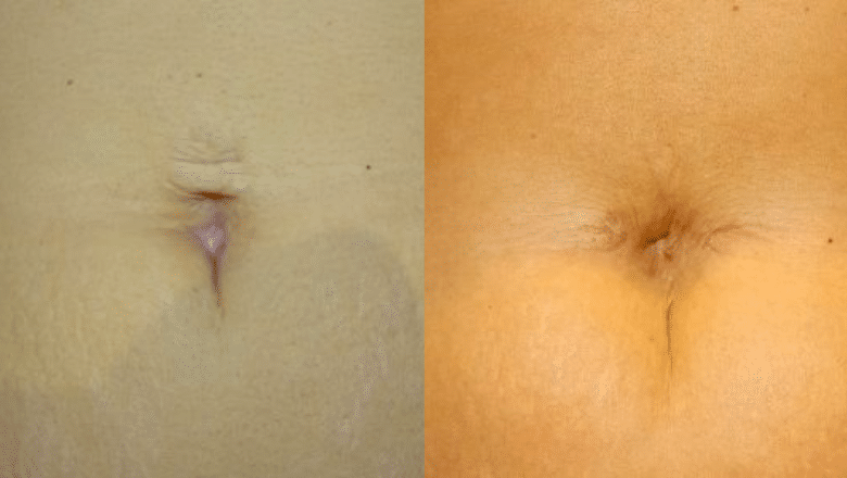 umbilical reconstruction before and after
