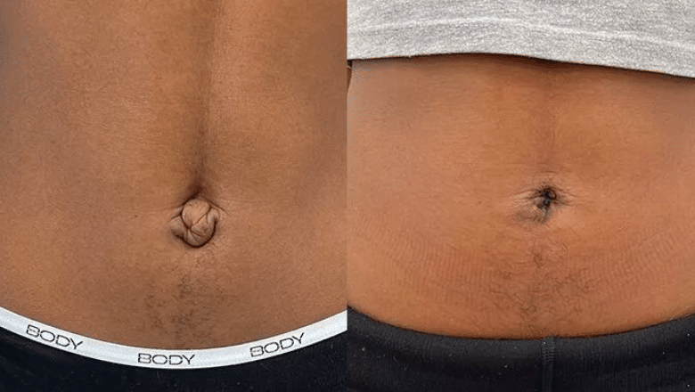 umbilical reconstruction surgery before and after