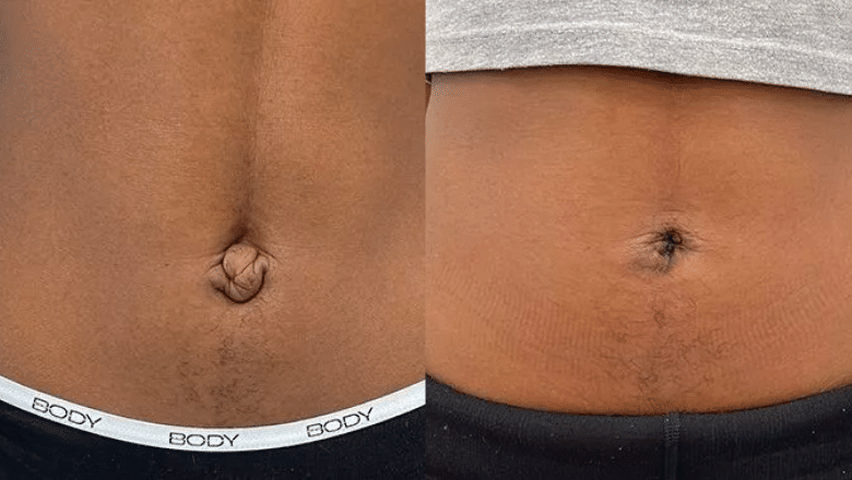 umbilical reconstruction surgery before and after 