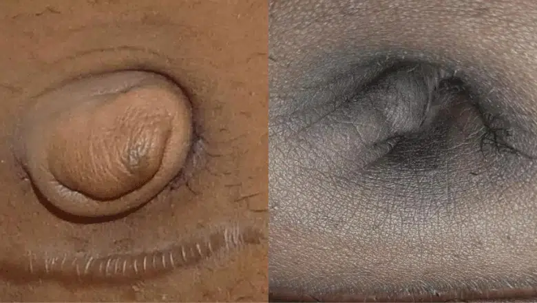 umbilicoplasty-surgery-before-and-after-.png.webp?format=webp&amp;nv=212368fc-2000-40d1-9026-c0f94abda644