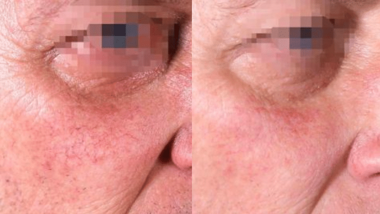veins on face laser removal before after