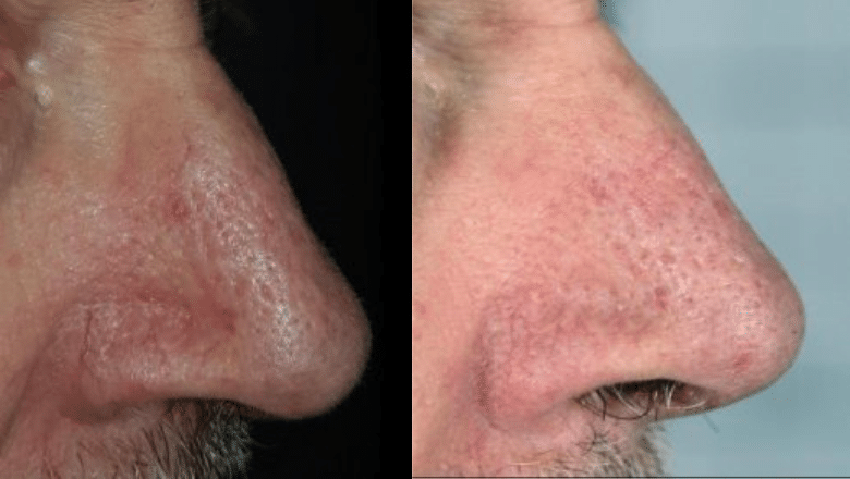 veins on nose laser removal before after