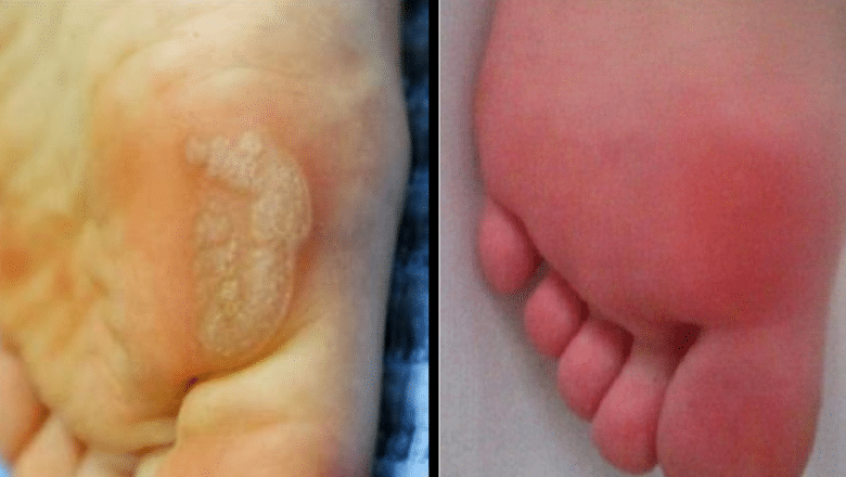 verruca laser removal before after