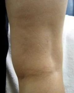 spider vein sclerotherapy before