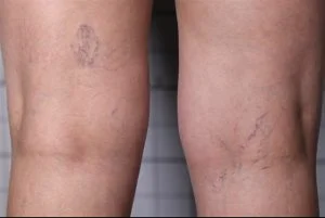 spider vein microsclerotherapy before