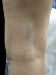 spider vein sclerotherapy before