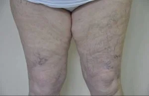 leg thread vein removal after