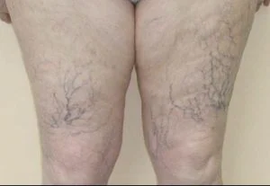 leg thread vein removal before