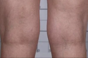 spider vein microsclerotherapy after