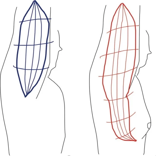 Traditional brachioplasty and exended brachioplasty incision design