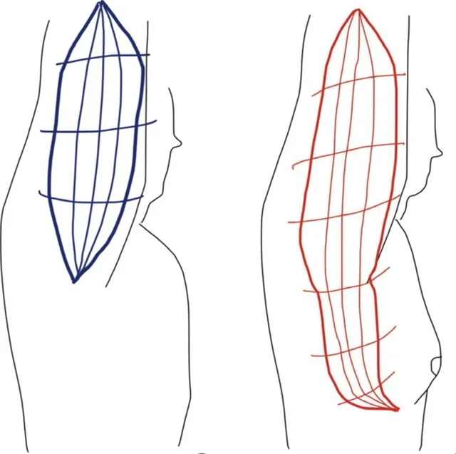 Traditional brachioplasty and exended brachioplasty incision design