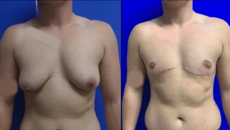 FtM Top surgery by Double Incision Mastectomy and Nipple Grafting 3950
