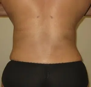 flank liposuction after