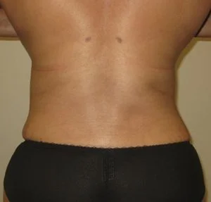 flank liposuction after