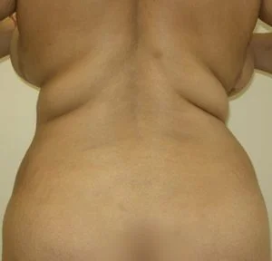 flank liposuction before