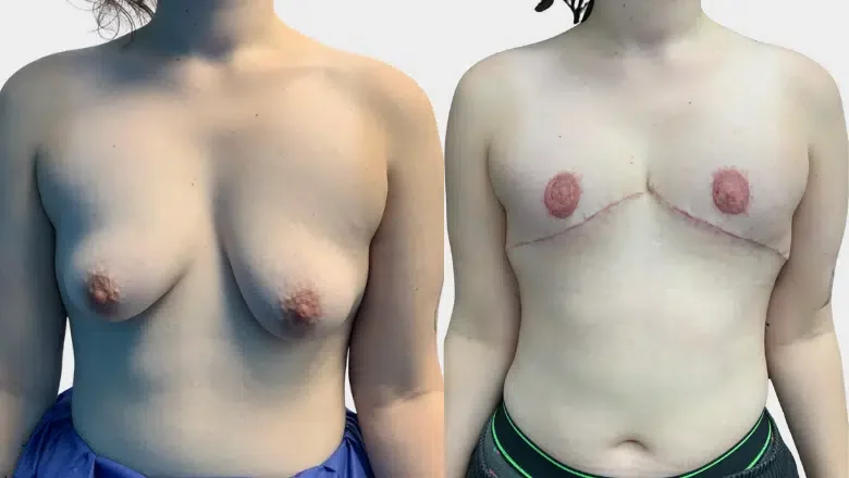 double incision mastectomy