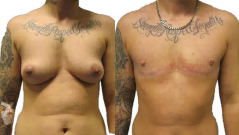 double-incision-mastectomy-before-after.png.webp?format=webp&nv=212368fc-2000-40d1-9026-c0f94abda644