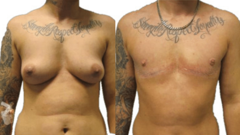 double incision mastectomy before after