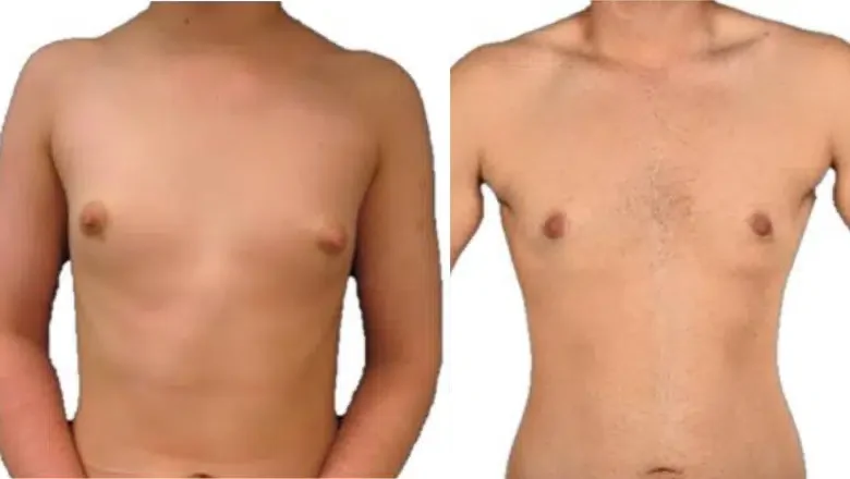 ftm periareolar mastectomy before after