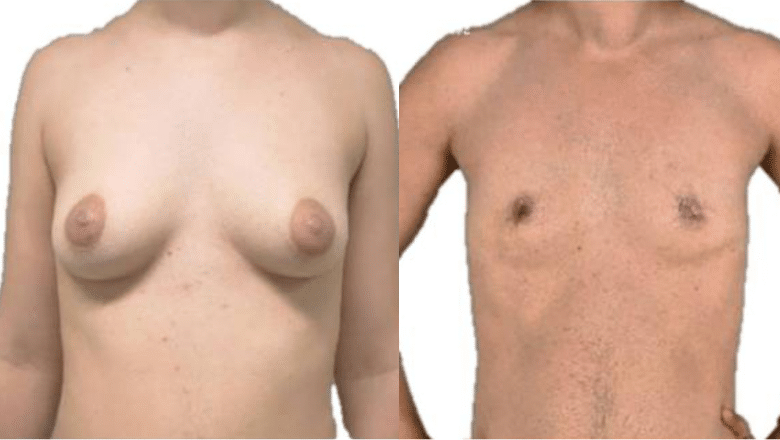 Female to male TOP Surgery result After 13 days