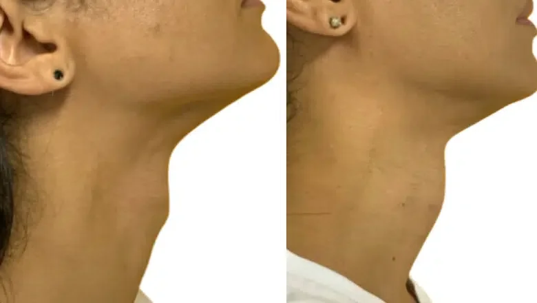 tracheal shave before after