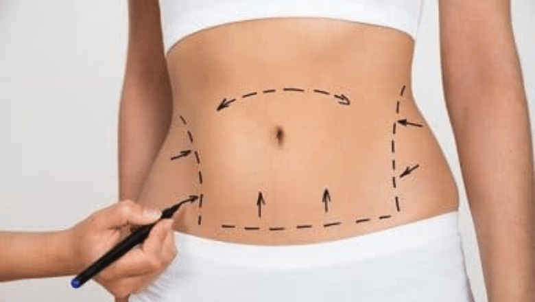 What to Expect After Liposuction