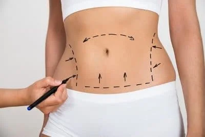 what to expect after liposuction