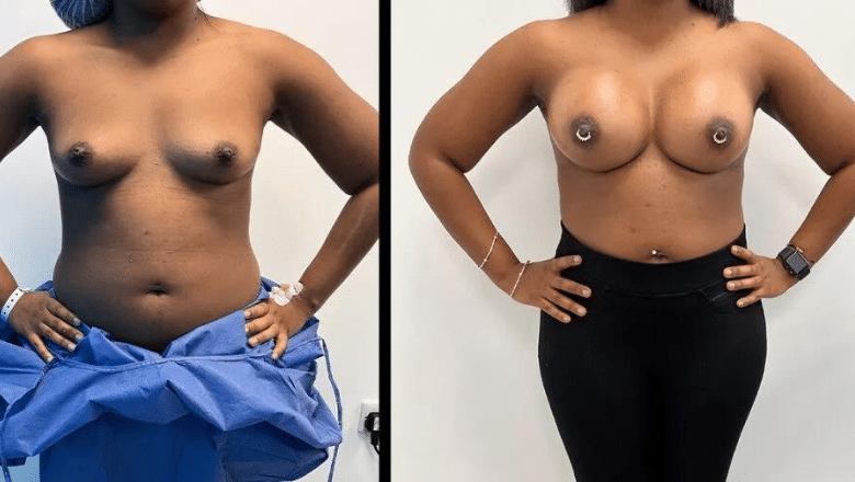 Breast implant photos London UK