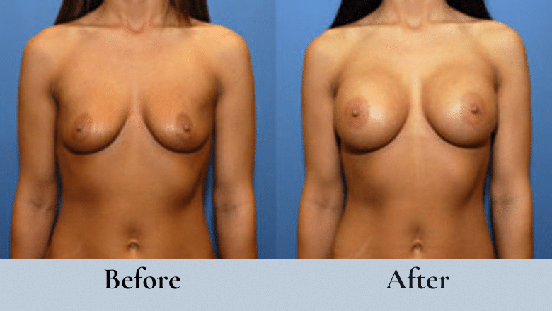 breast implants before after 2