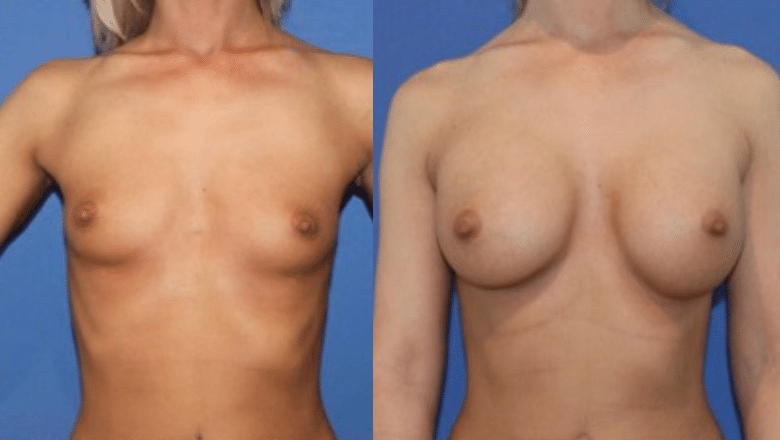 boob enhancement before after 1