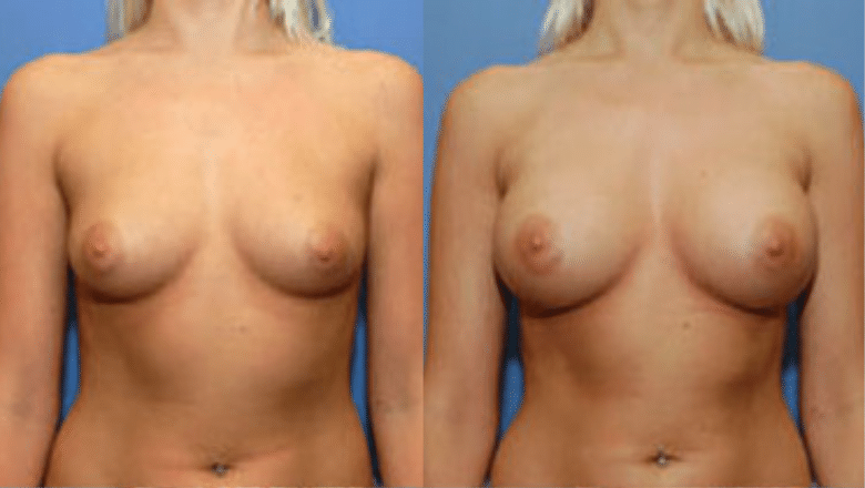 boob job london before after 3