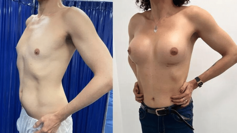 mini boob job before and after