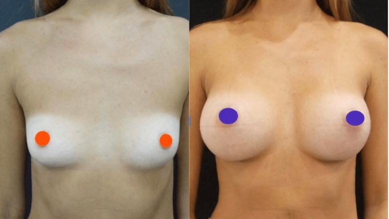 boob job before after 7