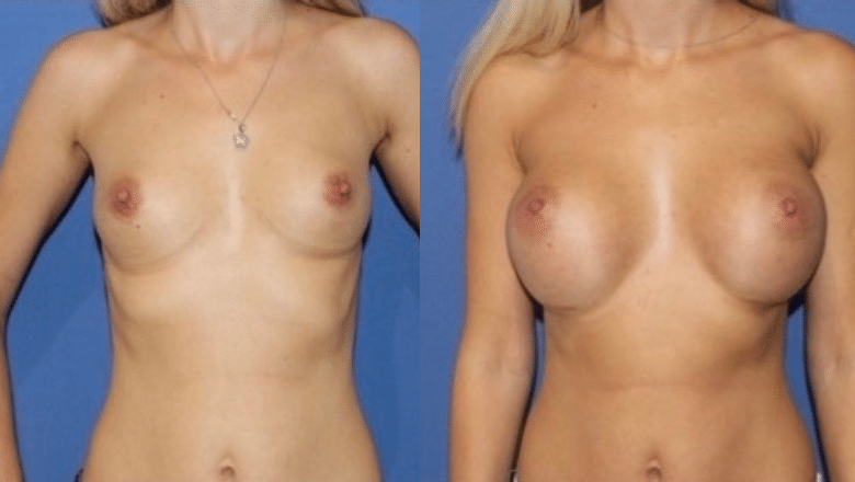 C Cup Boobs - Getting the Perfect Breast Augmentation