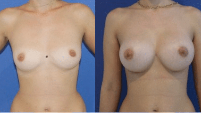 boob job london before and after 2