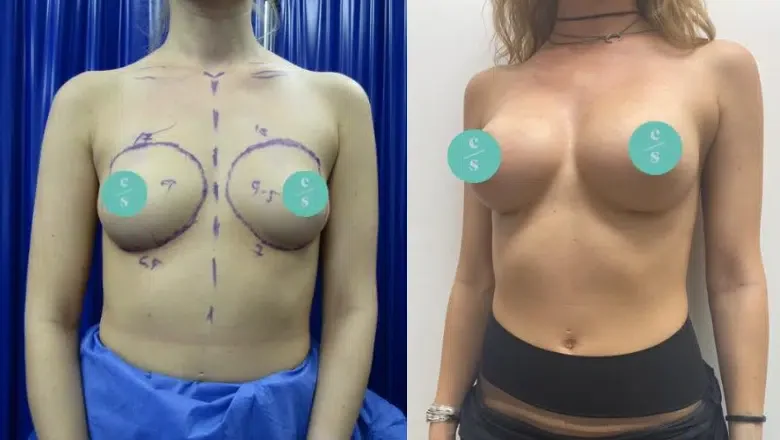 breast-augmentation-before-after-10.png.webp?format=webp&amp;nv=212368fc-2000-40d1-9026-c0f94abda644