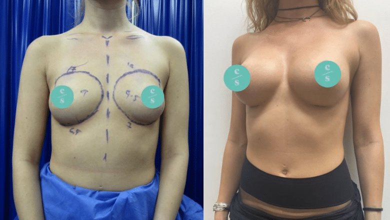 Options for Drooping Breasts after Weight Loss Centre for Surgery