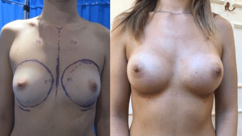 breast augmentation before after 3