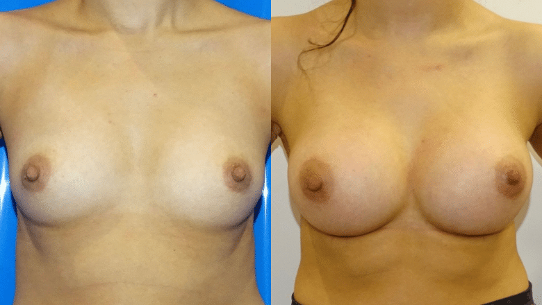 breast augmentation before after 5