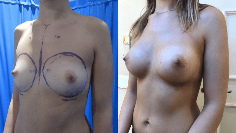 breast augmentation before after 6