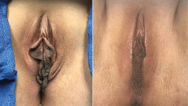 labiaplasty before after 10