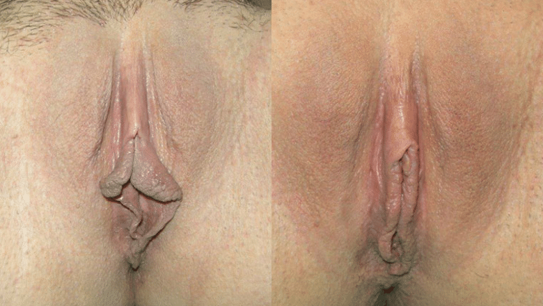 labiaplasty before after 2