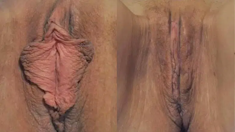 labiaplasty surgery before after 17