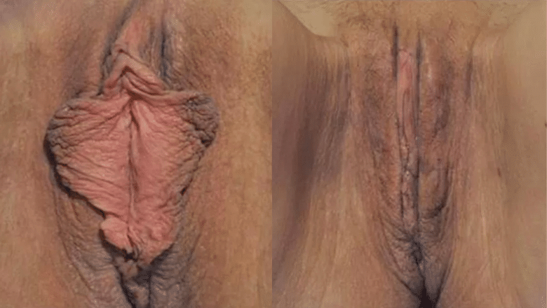 labiaplasty surgery before after 17