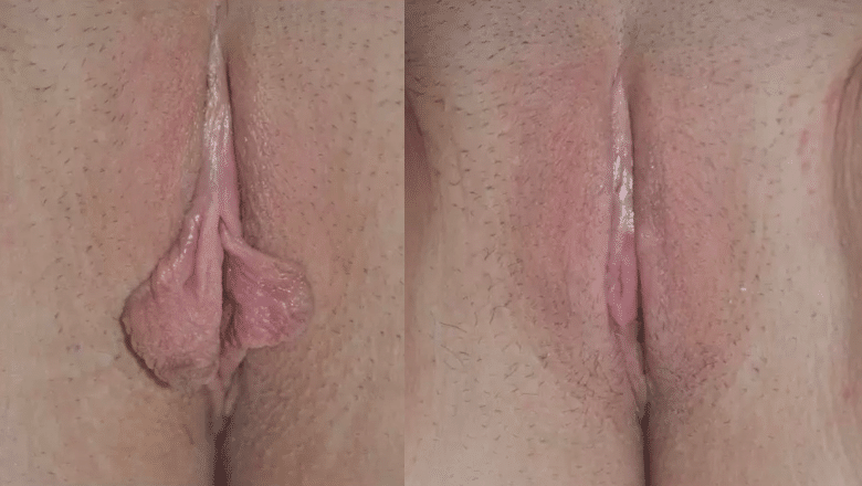 labiaplasty surgery before after 6